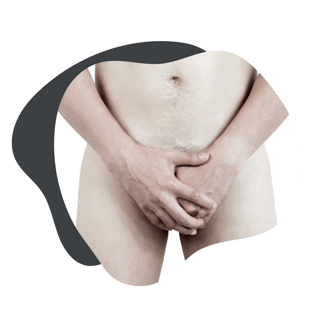 Ilustración de la localización de la placa fibrótica de Peyronie